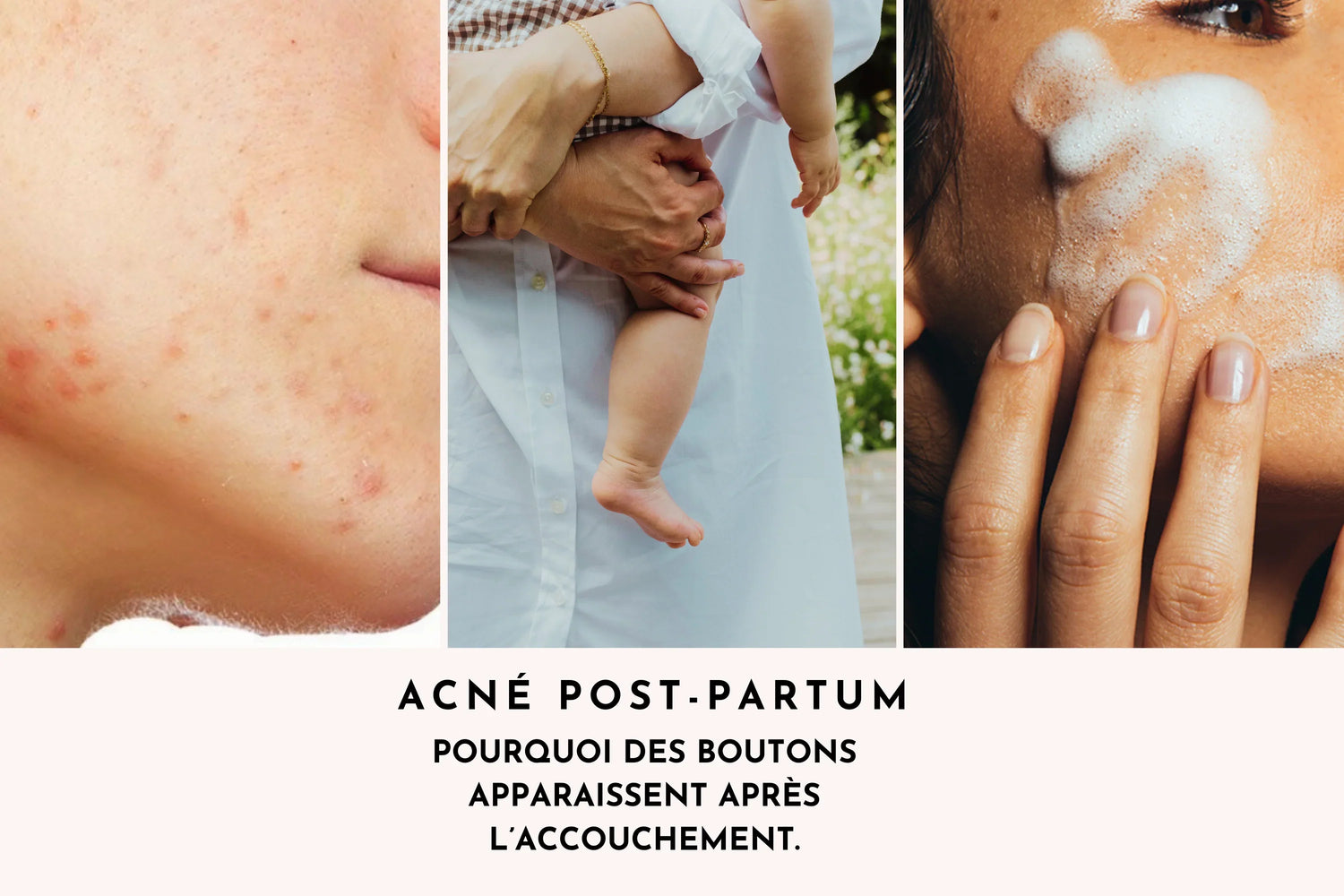 Acné post-partum : pourquoi des boutons apparaissent après l’accouchement ?